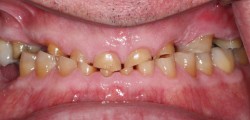 sudbury dentist dr martic crowns and implants before