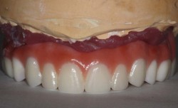 sudbury dentist dr martic fixed denture1