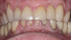 sudbury dentist dr martic rehabilitation after