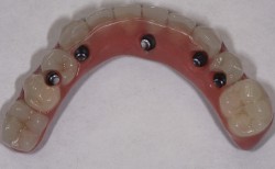 sudbury dentist dr martic screw retained denture on implants